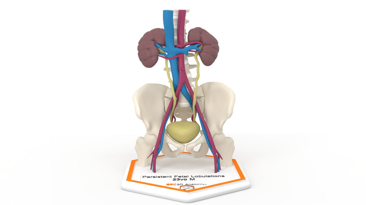 Persistent Fetal Lobulation