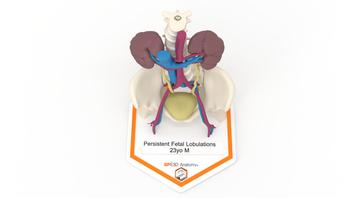 Persistent Fetal Lobulation