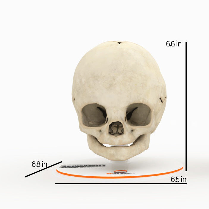 Infant Skull With Craniosynostosis of the Sagittal Suture - Male, 8 Months