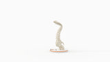 Severe Kyphosis