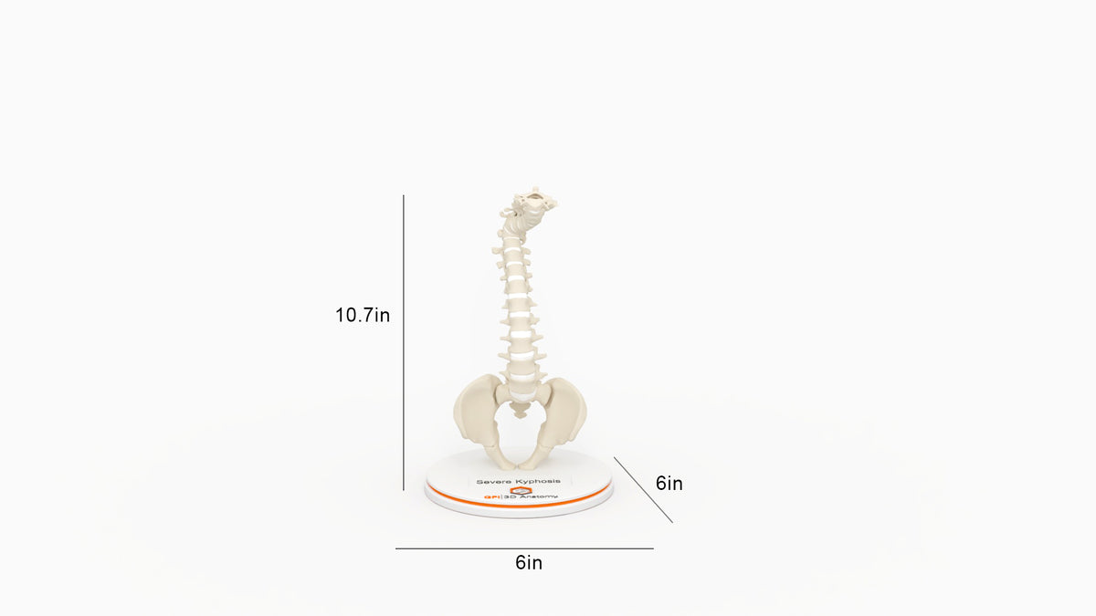 Severe Kyphosis