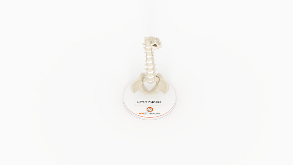 Severe Kyphosis