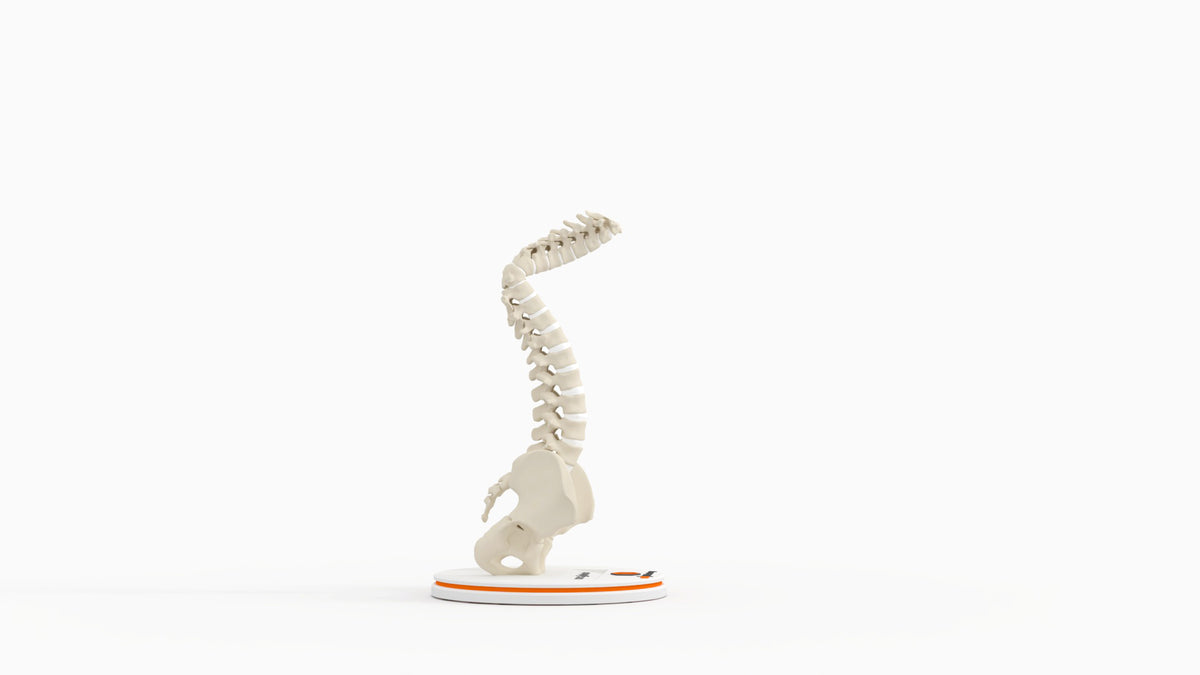 Severe Kyphosis