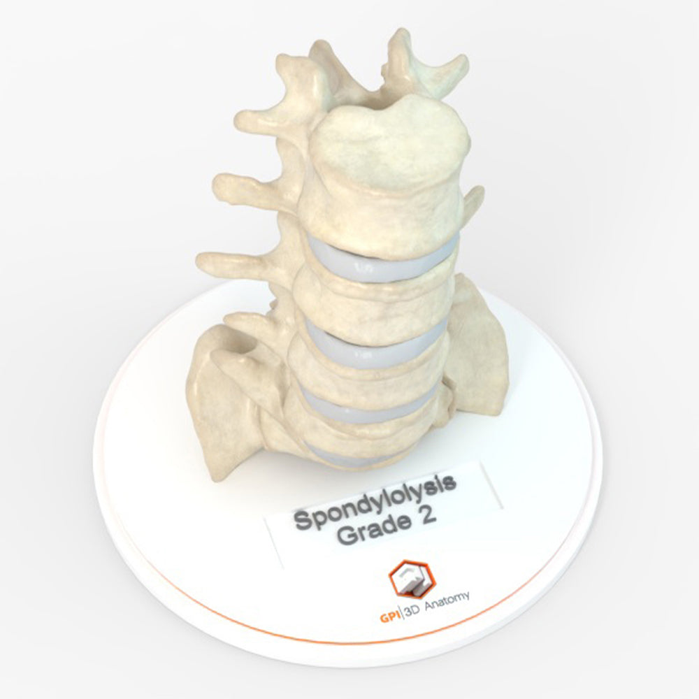 Spine With Bilateral Spondylolysis (Pars Defect), Grade 2 – Male, 27 years