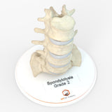 Spine With Bilateral Spondylolysis (Pars Defect), Grade 2 – Male, 27 years