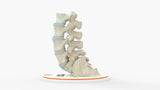 Spine With Spondylolisthesis (Anterolisthesis), Grade 3 – Female, 17 Years