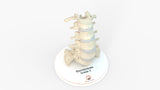 Spine With Spondylolysis (Pars Defect), Grade 4 – Female, 16 Years