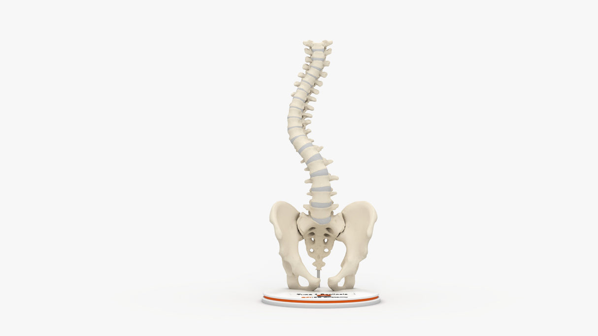 Scoliosis Type-1 Idiopathic 10