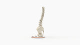 Scoliosis Type-1 Idiopathic 10