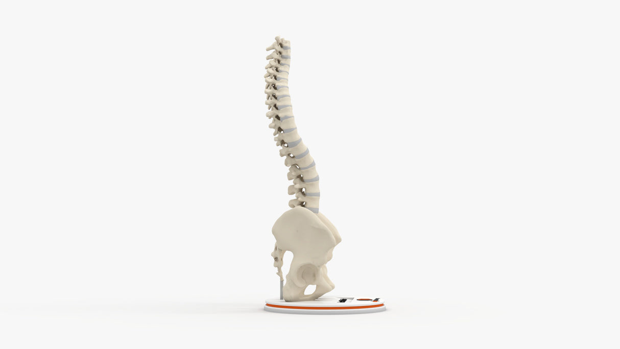 Scoliosis Type-1 Idiopathic 10