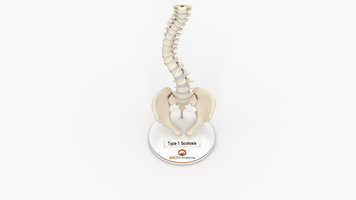 Scoliosis Type-1 Idiopathic 10