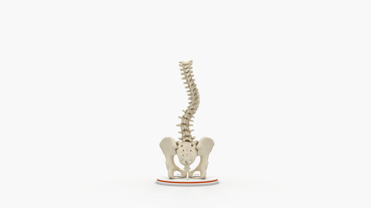 Scoliosis Type-1 Idiopathic 1