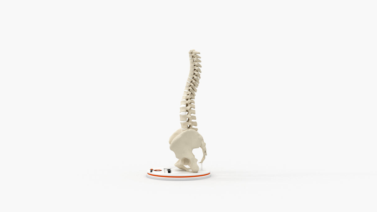Scoliosis Type-1 Idiopathic 1