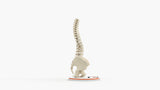 Scoliosis Type-1 Idiopathic 1