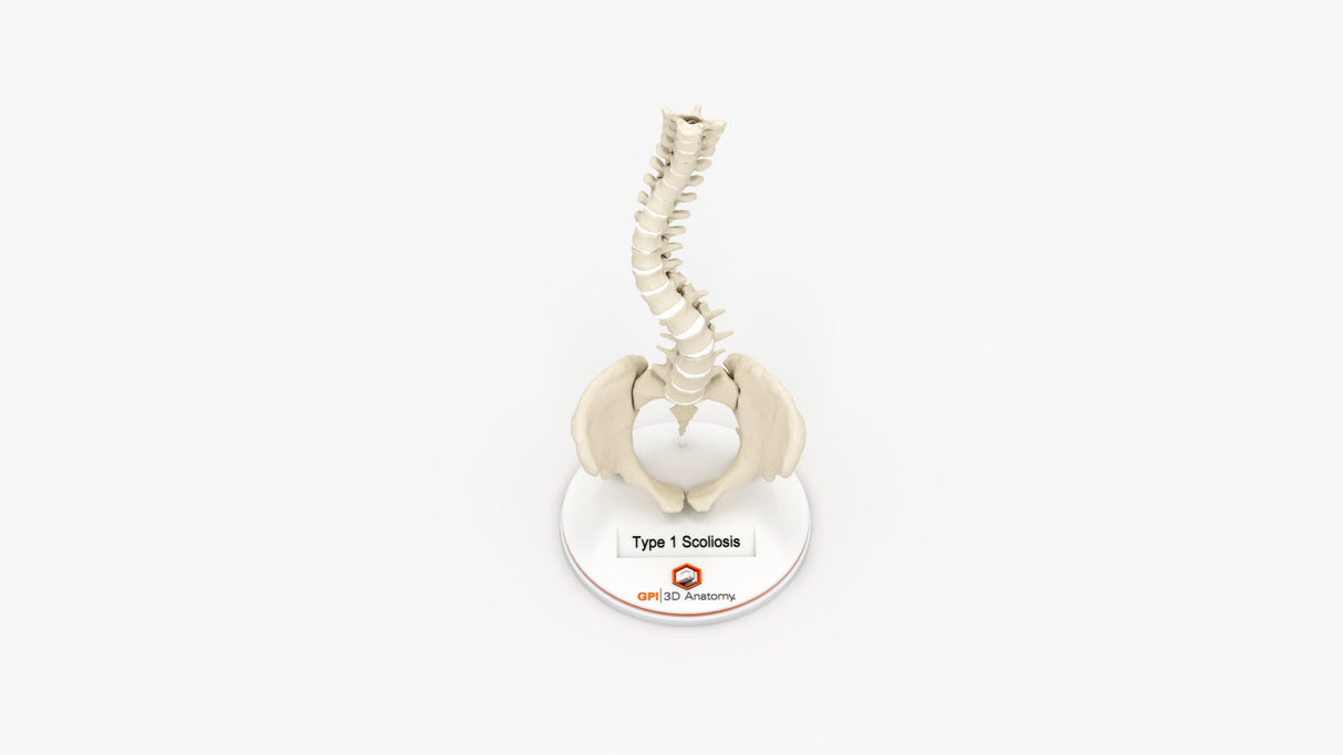 Scoliosis Type-1 Idiopathic 1