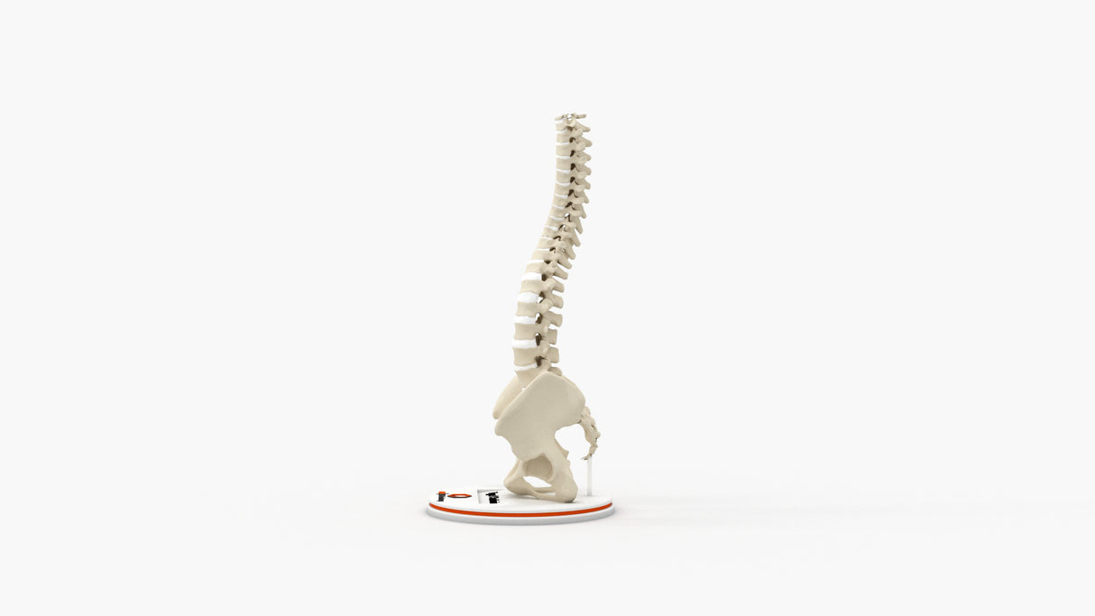 Scoliosis Type-1 Idiopathic 2
