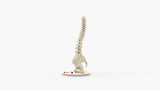 Scoliosis Type-1 Idiopathic 2
