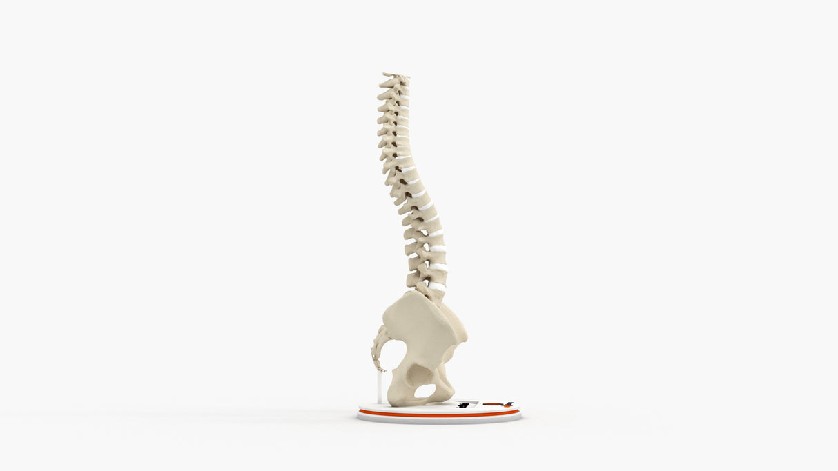 Scoliosis Type-1 Idiopathic 2
