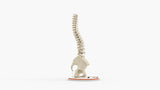 Scoliosis Type-1 Idiopathic 2