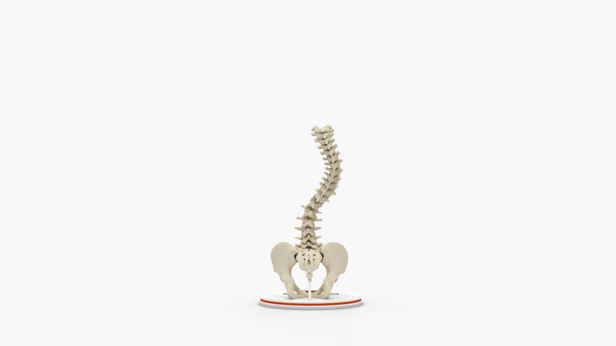 Scoliosis Type-1 Idiopathic 4