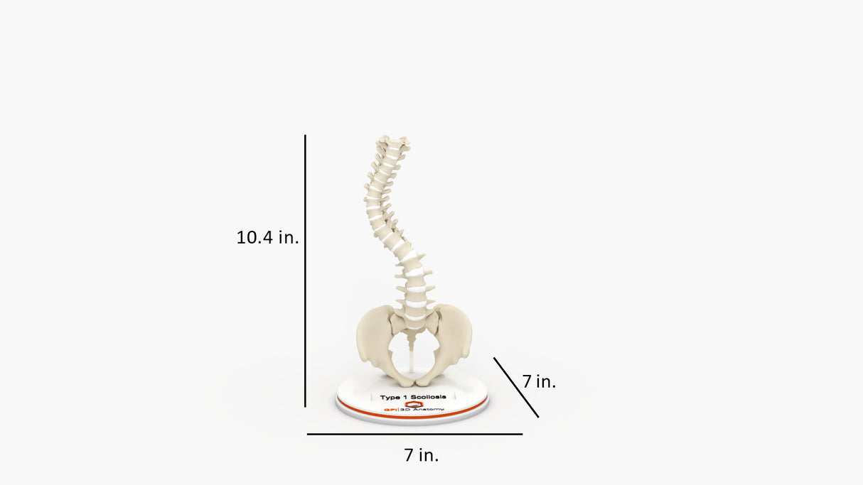 Scoliosis Type-1 Idiopathic 4
