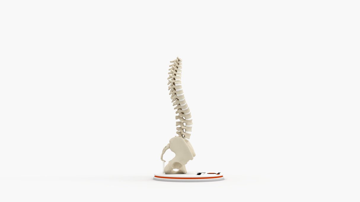 Scoliosis Type-1 Idiopathic 4