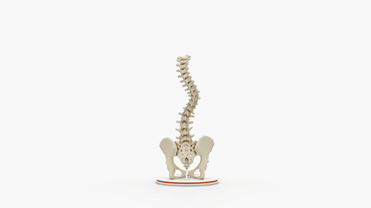 Scoliosis Type-1 Idiopathic 5