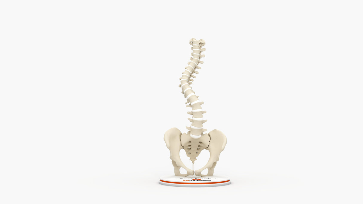 Scoliosis Type-1 Idiopathic 5