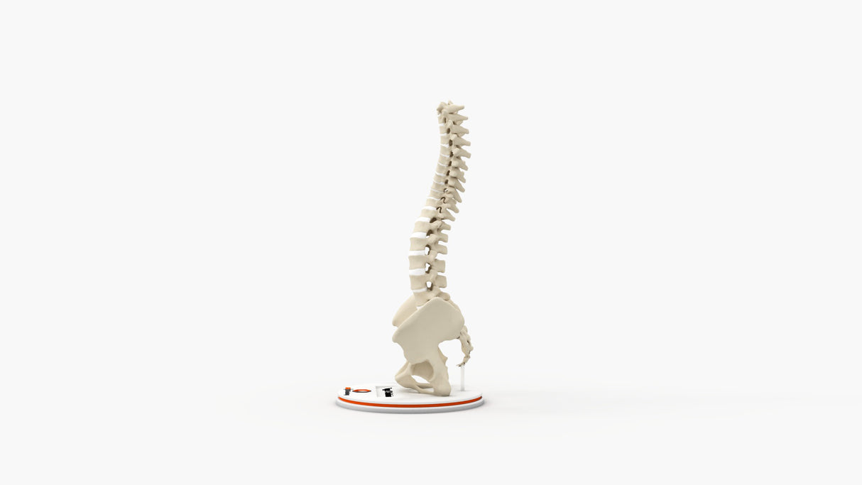 Scoliosis Type-1 Idiopathic 5