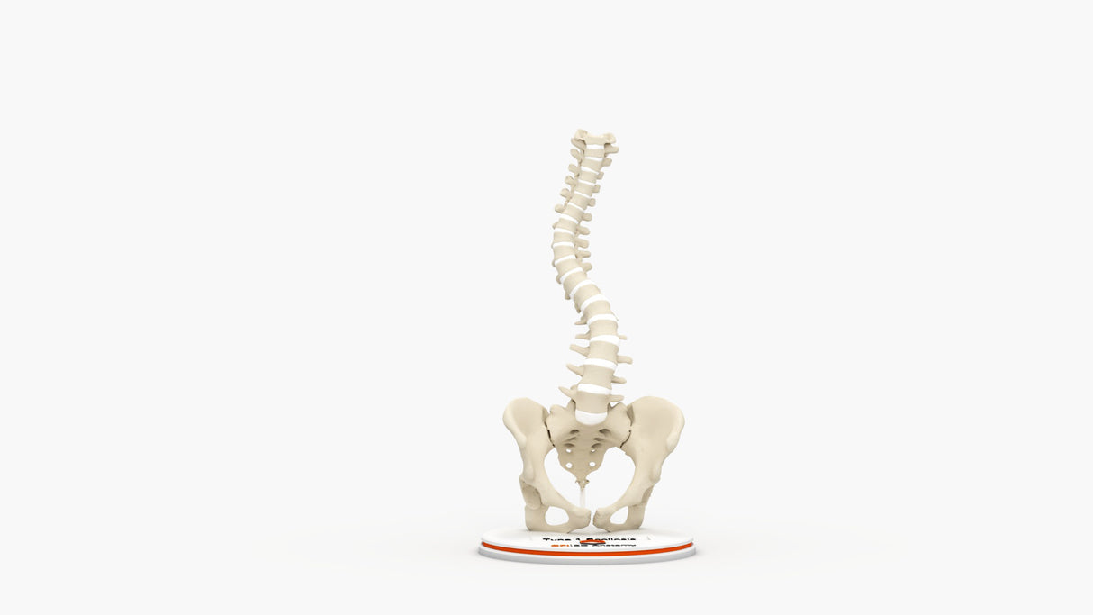 Scoliosis Type-1 Idiopathic 6