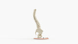 Scoliosis Type-1 Idiopathic 6