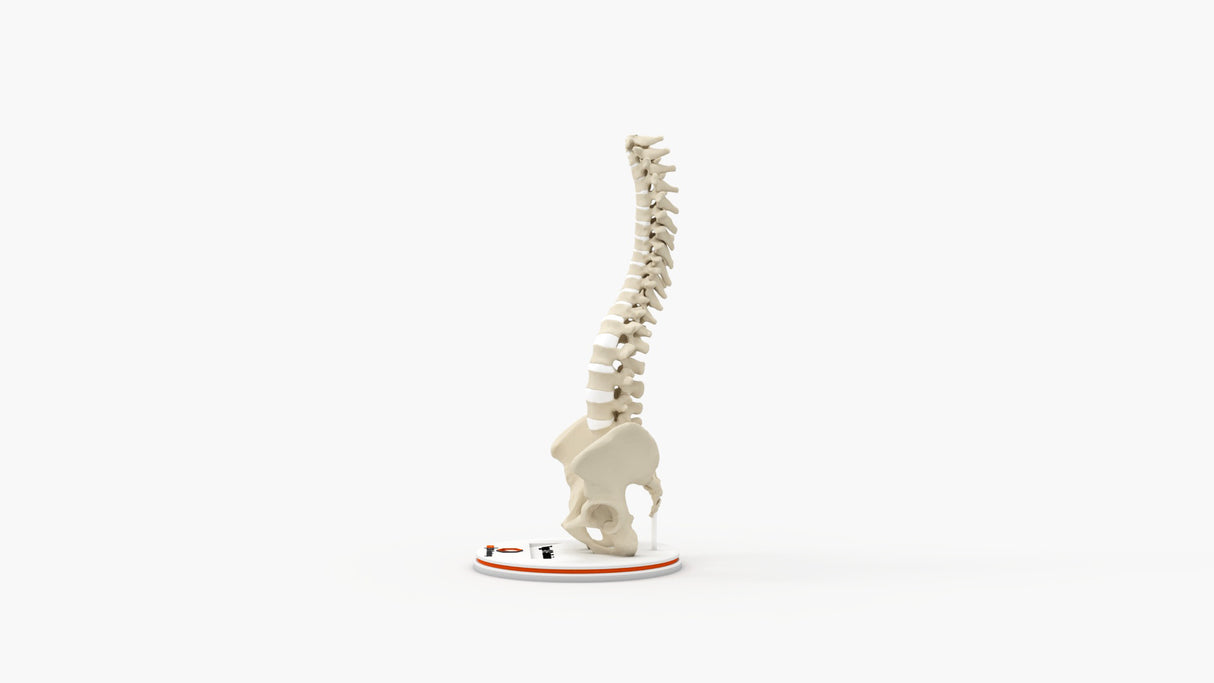 Scoliosis Type-1 Idiopathic 7