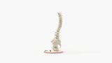 Scoliosis Type-1 Idiopathic 7
