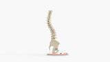 Scoliosis Type-1 Idiopathic 7
