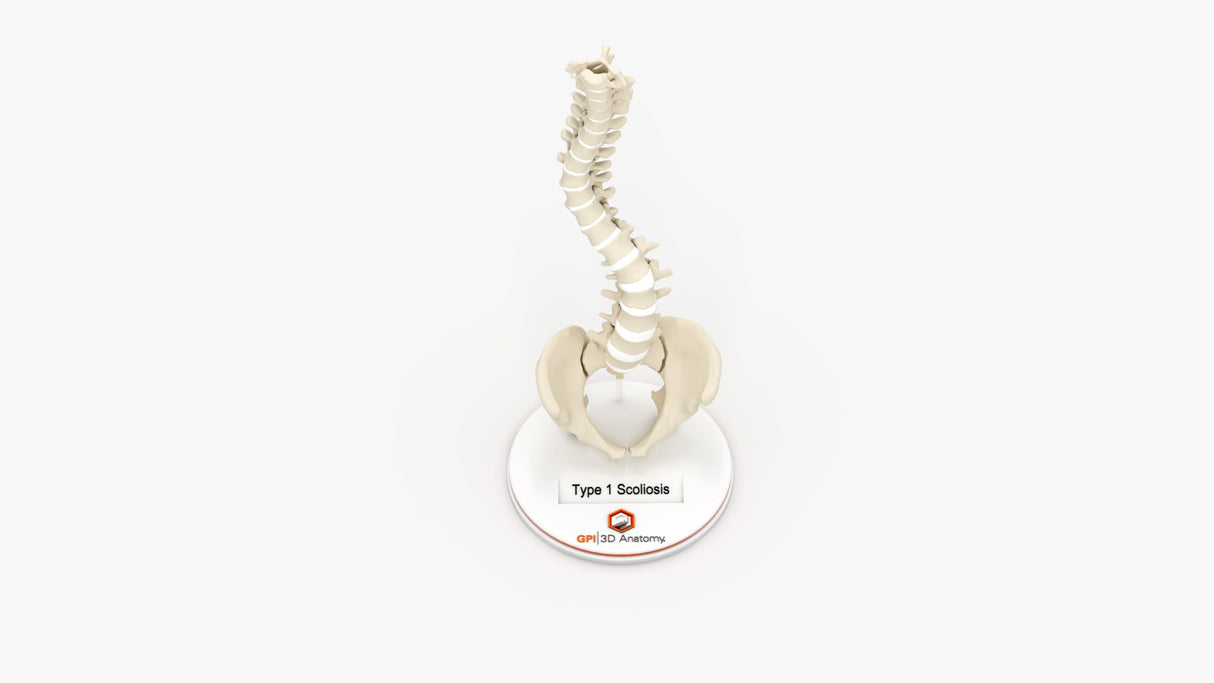 Scoliosis Type-1 Idiopathic 7