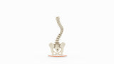 Scoliosis Type-1 Idiopathic 9