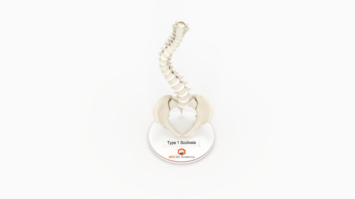 Scoliosis Type-1 Idiopathic 9