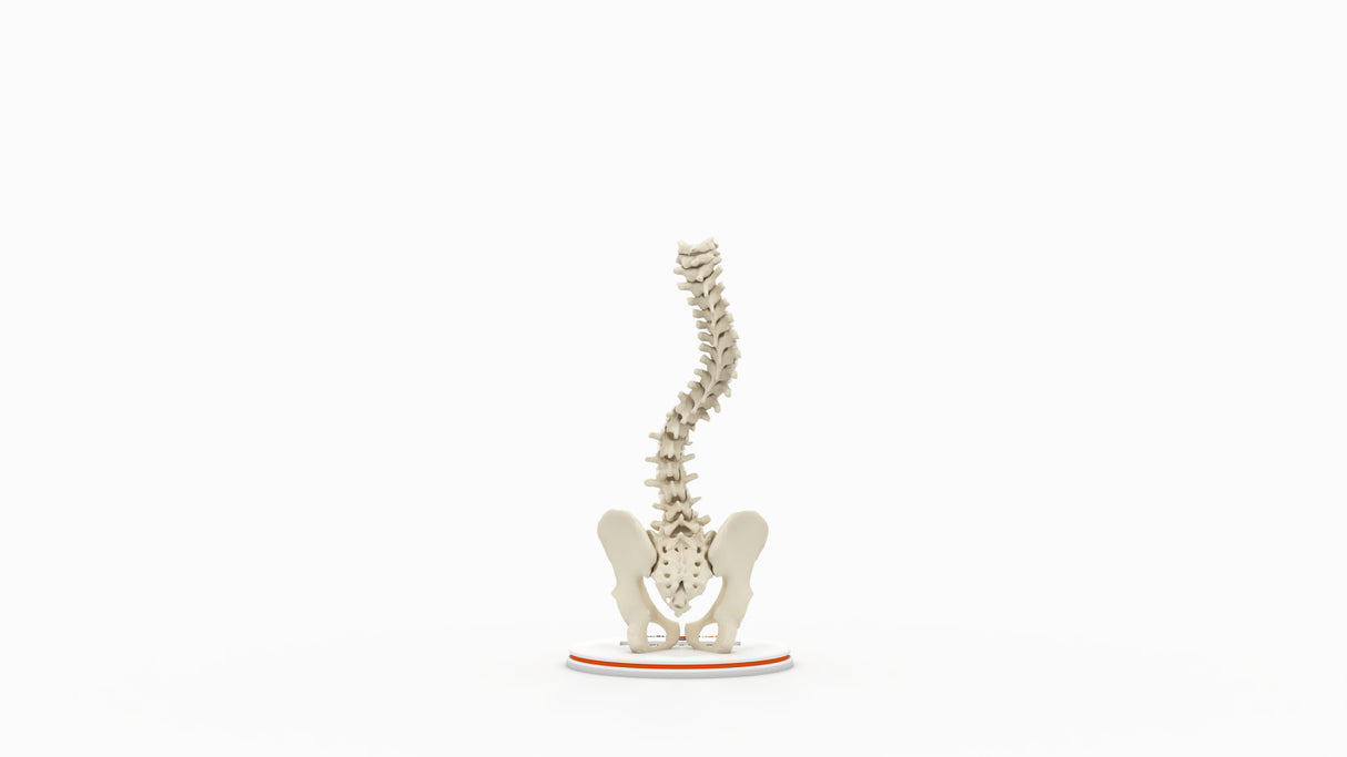Scoliosis Type-2 Model 1