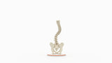 Scoliosis Type-2 Model 1