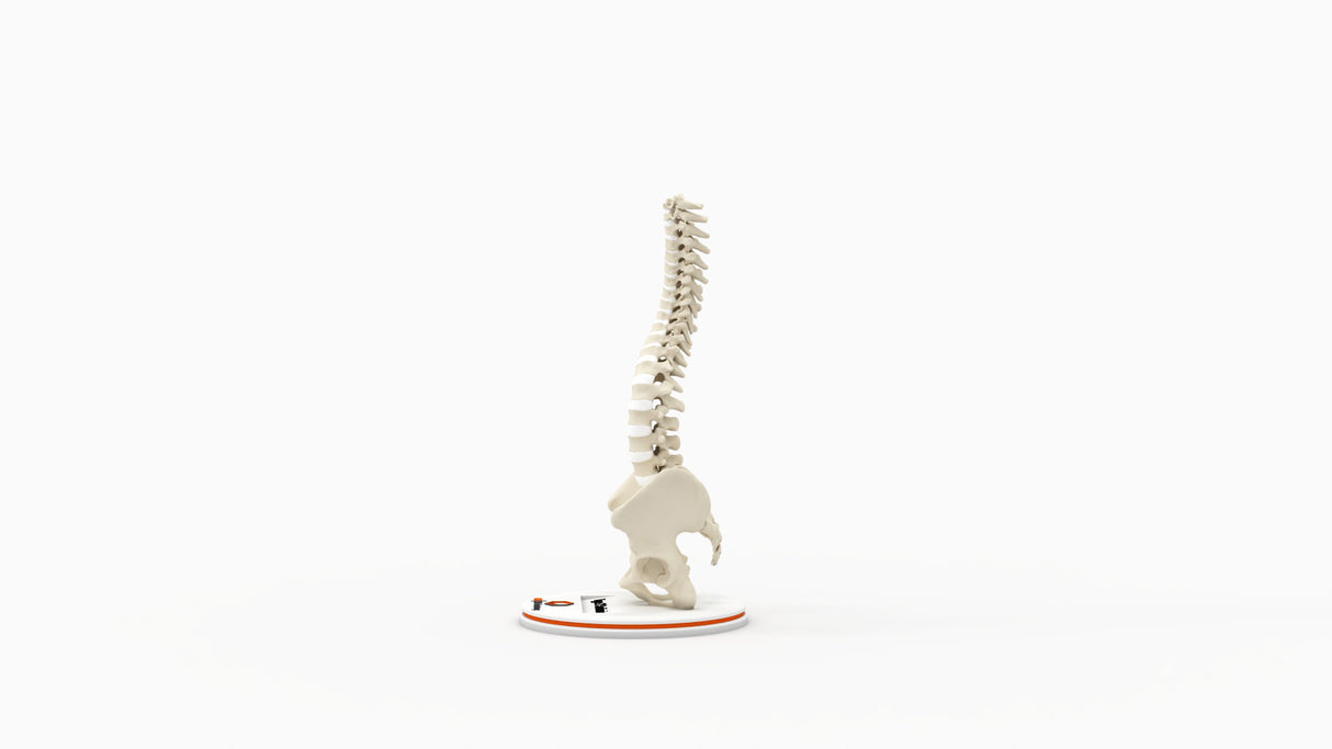 Scoliosis Type-2 Model 1