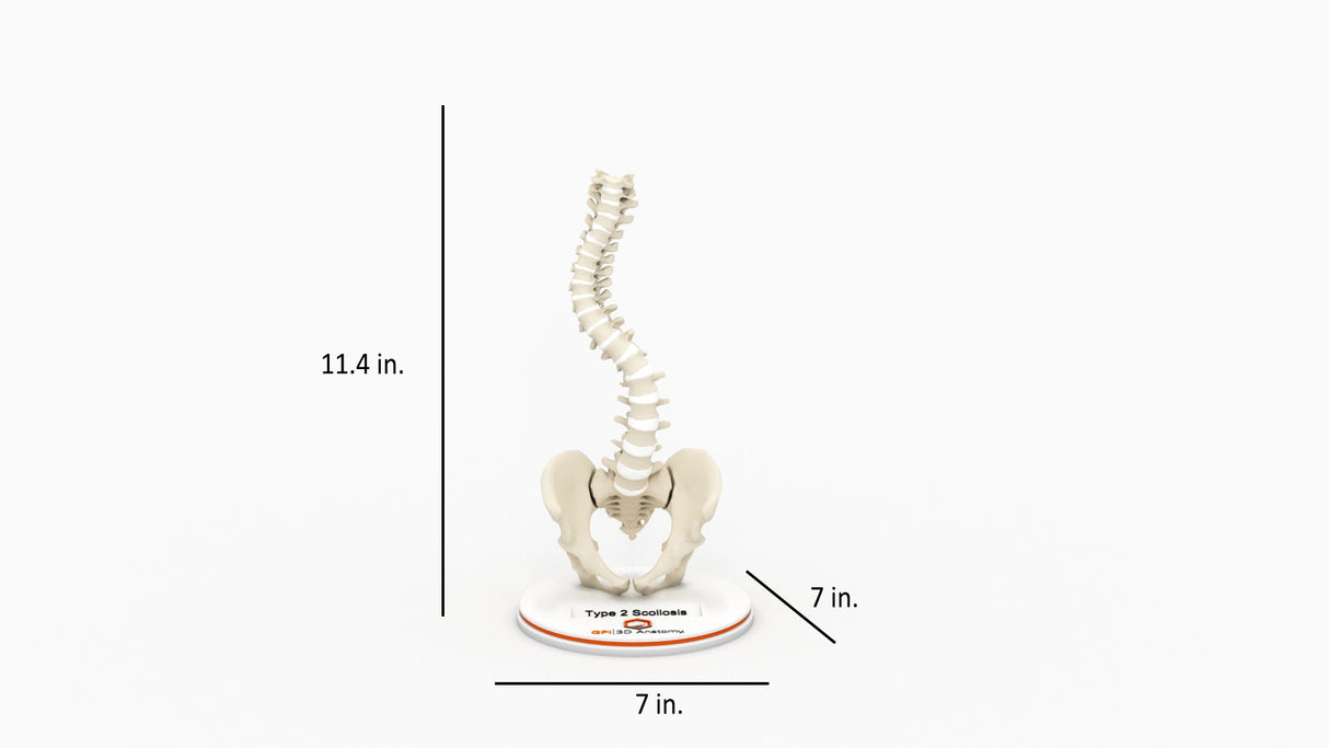 Scoliosis Type-2 Model 1