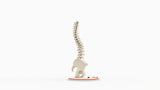 Scoliosis Type-2 Model 1