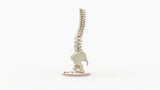 Scoliosis Type-2 Model 2