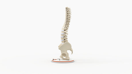 Scoliosis Type-2 Model 2