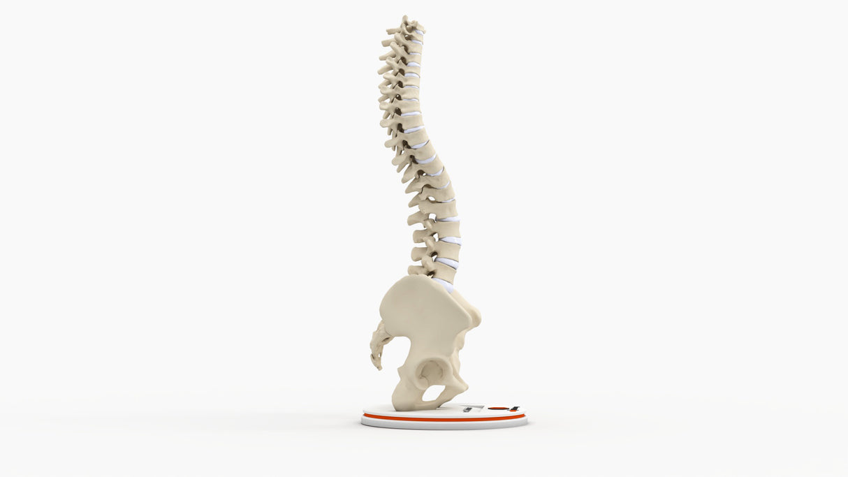 Scoliosis Type-2 Model 2
