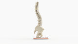 Scoliosis Type-2 Model 2