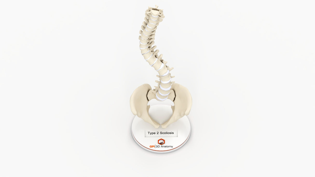 Scoliosis Type-2 Model 2