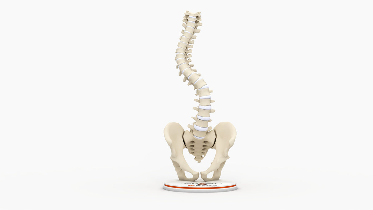 Scoliosis Type-2 Model 2