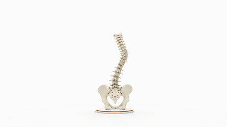 Scoliosis Type-2 Model 3