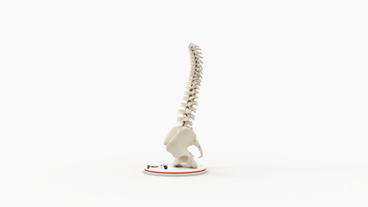 Scoliosis Type-2 Model 3